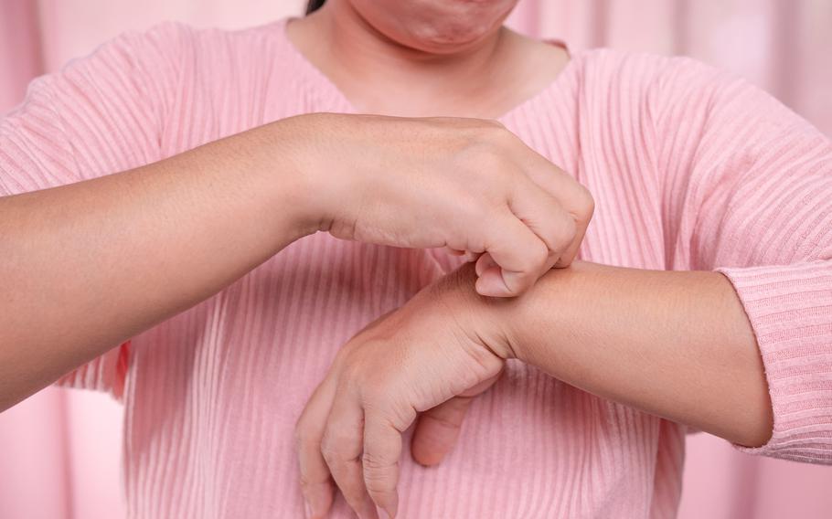 Annoyed middle-aged woman scratching itch on her arm from itchy dry skin, eczema, dermatitis, allergy, psoriasis. Health care and skin disease concept.